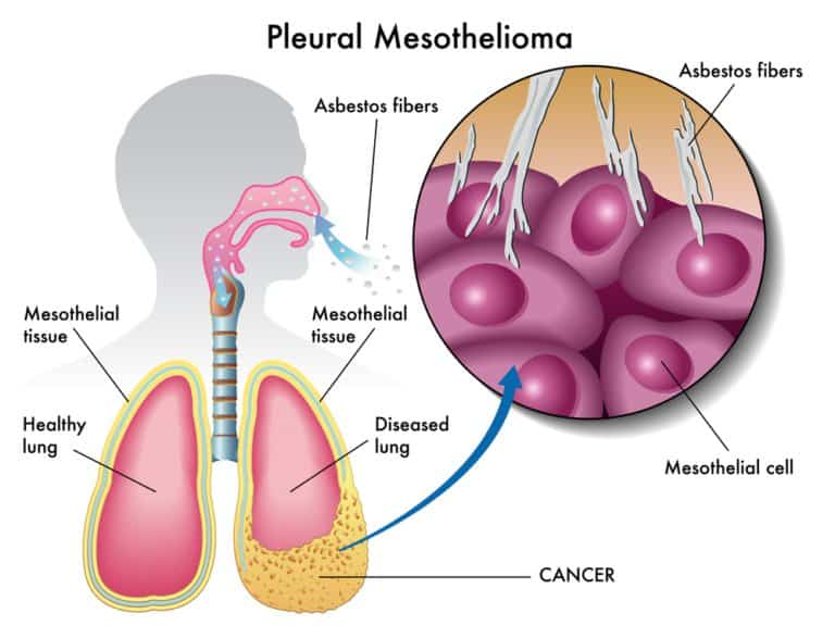 vermiculite insulation can cause mesothelioma